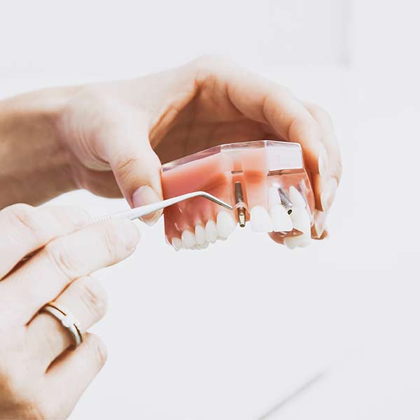 Kirkland Dental Implant Seattle Dental Implant Lake Washington Dental